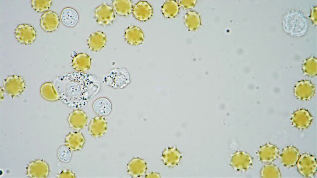 White Blood cell neutralising pathogen causing infection by phagocytosis. 