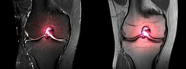 Magnetic resonance imaging or MRI of knee.Closed injury of the knee joint, with manifestations of arthrosis.Knee pain in sport injury.Orthopedic surgeon plan cruciate ligament reconstruction surgery. - obrazy, fototapety, plakaty