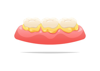 plaque on teeth and gums. Dental health concept. Vector illustration.