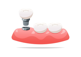 Dental implants and gums. Dental health concept. Vector illustration.
