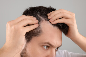 Fototapeta premium Man with dandruff in his dark hair on light gray background, closeup
