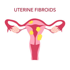 Uterine fibroids disease in flat design vector illustration.