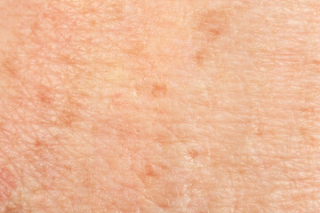 Texture of skin with pigmentation as background, macro view - obrazy, fototapety, plakaty