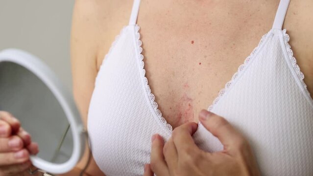 4K A woman in a bra noticed dermatitis on her chest. 