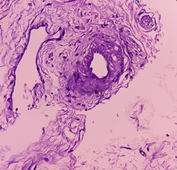 Prostatic Tissue (biopsy): Sections show show fatty tissue, neural tissue and muscle tissue. Prostate cancer diagnosis. - obrazy, fototapety, plakaty