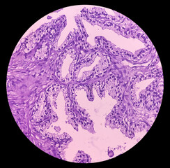 Prostatic chips (TURP): Adenocarcinoma. Sections show core of prostatic tissue. It reveals an...