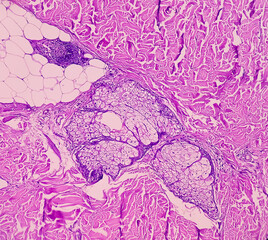 Lipoma on loin, benign growth of fatty tissue, benign neoplasm, adipocytes, partially capsulated...