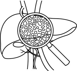Liver Disease for Coloring Page. Cirrhosis of the Liver under a Magnifying Glass. Vector Illustration of Human Organs. Anatomy and Medicine