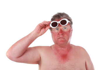 Sunburned man lifting sunglasses showing tan lines