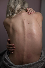 Caucasian woman after massage with vacuum cups. Vertical photo.