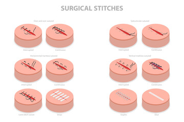 3D Isometric Flat  Conceptual Illustration of Surgical Stitches, Medical Suture