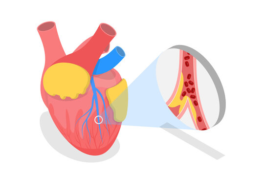 3D Isometric Flat  Conceptual Illustration of Myocardial Infarction, Heart Attack