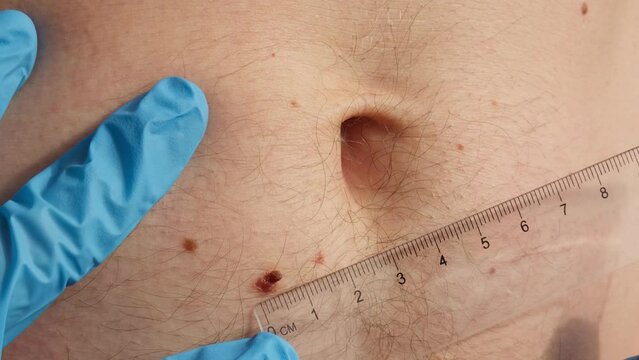 Dermatologist checking male birthmarks with ruler. Doctor examining length and width of benign moles on man skin Pigmentation. 