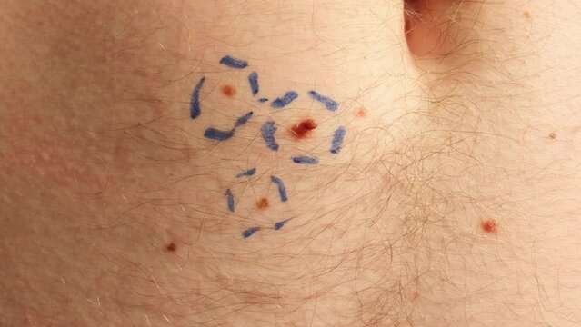 Dermatologist apply skin cream on male birthmarks. Checking benign moles. Presentation of skin cancer procedure. Doctor checking skin tags on man