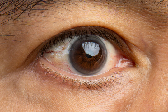 Senior man eye strain after for long stretches at computer or digital screens.