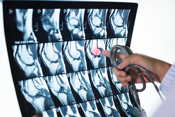 Doctor hand pointing patient bone x-ray film before surgery.Image MRI and CT scan at radiology orthopedic department in hospital.Knee join xray for treatment.Selective focus.