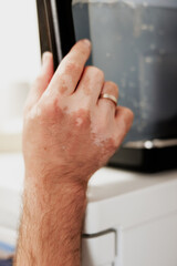 Close up of a human hand with spots of vitiligo disease on the skin