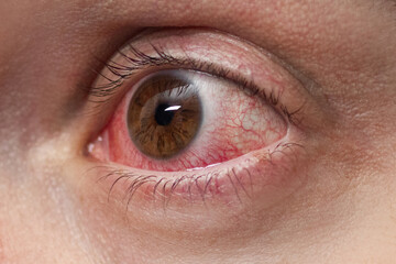 Red eye of a patient with conjunctivitis, close up