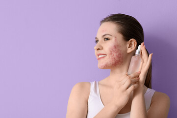 Young woman with acne problem and serum on lilac background, closeup