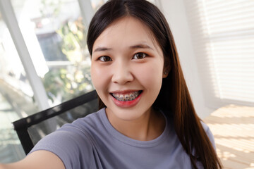 Closeup Braces smile portrait of Asian college student girl smiling and taking selfie.