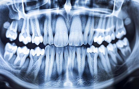 x-ray image of teeth, pororamic image of the teeth