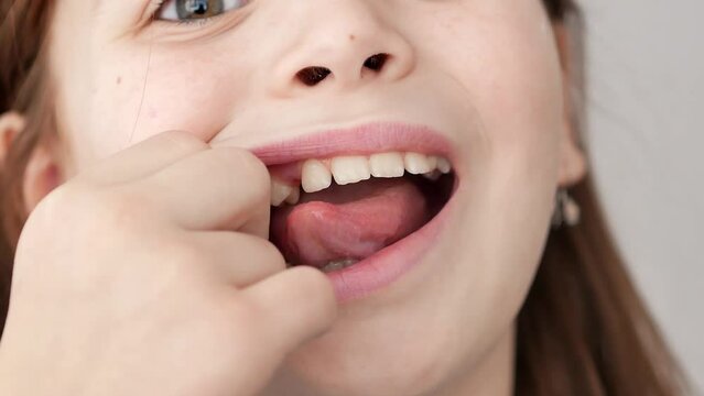 Caucasian brunette girl, shows a gap from a fallen baby tooth with her tongue, lifts her lip with her finger, loss of the first premolar.
