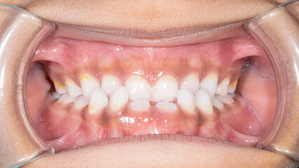 Dental orthodontics case. Front view of a young girl biting teeth. Lips retracted with cheek...