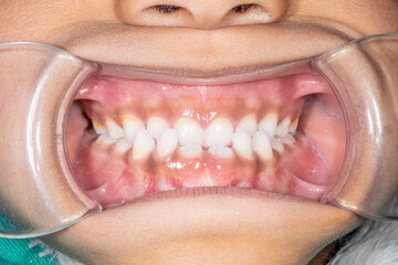 Obraz premium Dental orthodontics case. Frontal view of a young girl biting teeth. Lips retracted with cheek retractor with a skeletal Class III malocclusion, retruded maxilla or protruded mandible. 