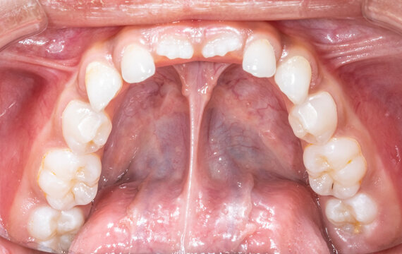 Lower mandibular arch occlusal indirect mirror view of a child milky dentition and permanent incisors erupting, teeth aligned and no decay. Gingival gum, tongue lifted with lingual frenulum.