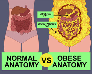 Normal anatomy vs obese anatomy. Body fat problems. Banner, snippet. Healthcare illustration. Vector illustration. 