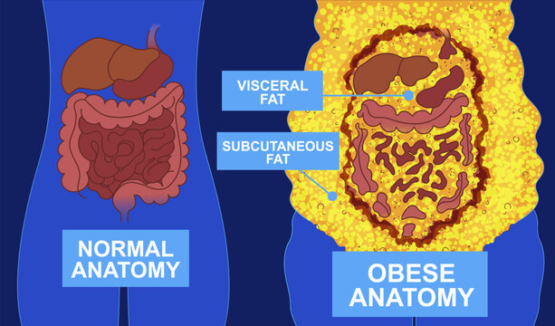 Normal anatomy vs obese anatomy. Body fat problems. Banner, snippet. Healthcare illustration. Vector illustration. 