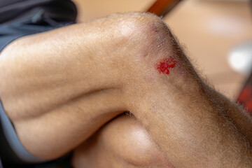 First aid and injuries concept, A man show his leg with little bit lesion and bleeding on skin,...