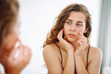 Skin Problem. Depressed Woman Touching Pimple On Face Looking At Mirror. Allergic reaction from...
