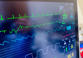 hospital monitor displaying vital signs, emphasizing healthcare, technology, and patient well-being