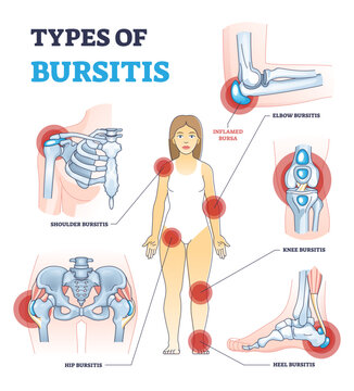 Types of bursitis as medical body joints inflammation list outline diagram, transparent background. Labeled educational painful condition examples with shoulder, hip, heel.
