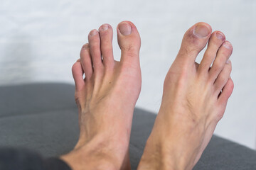 A man's toes showing what looks like a rash with red blotchy skin. A common side effect of Covid-19...
