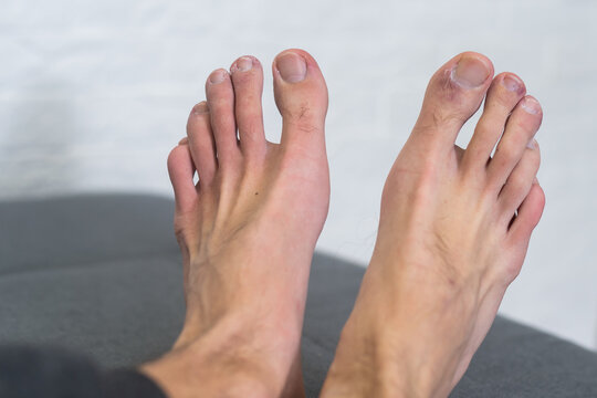 A man's toes showing what looks like a rash with red blotchy skin. A common side effect of Covid-19 often referred to as Covid toe .