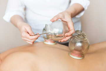Fire cupping cups on back of female patient in Acupuncture therapy