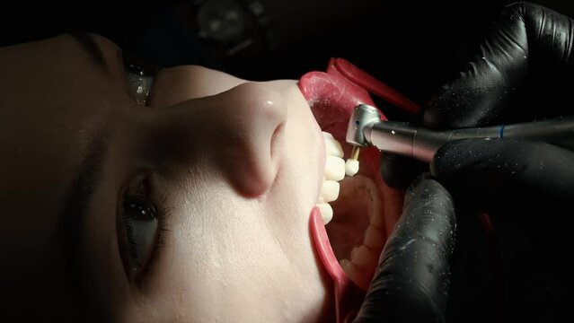 The orthodontist removes the remaining material from the patient's teeth after removing the braces. Grinding of teeth.