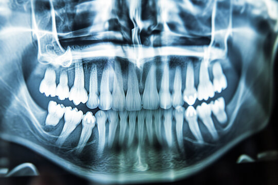 dental x ray image