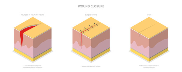 3D Isometric Flat Conceptual Illustration of Wound Closure, Tissue Injury Healing