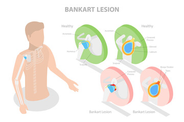 3D Isometric Flat  Conceptual Illustration of Bankart Lesion, Educational Diagram