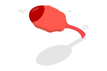 3D Isometric Flat  Conceptual Illustration of Endometrioma, Ovarian Cyst