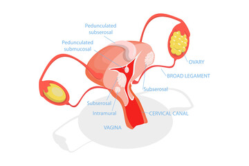 3D Isometric Flat  Conceptual Illustration of Types Of Uterine Fibroids, Human Anatomy - obrazy, fototapety, plakaty