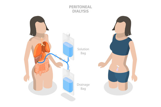 3D Isometric Flat  Conceptual Illustration of Peritoneal Dialysis, Explanation Diagram