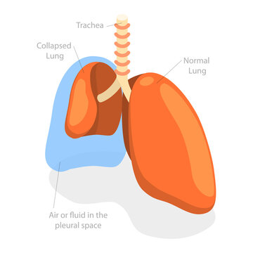 3D Isometric Flat  Conceptual Illustration of Collapsed Lung, Respiratory System Issue