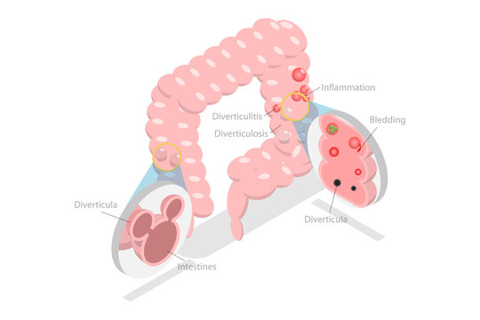 3D Isometric Flat  Conceptual Illustration of Diverticulosis And Diverticulitis, Medical Structure and Location