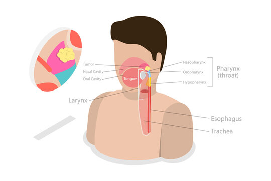 3D Isometric Flat  Conceptual Illustration of Nasopharyngeal Carcinoma Tumor, Educational Diagram