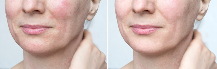 Woman with problem skin before after treatment. Healthy skin and cosmetic care.
