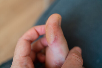 Close-up of a soft callus on a foot of a woman, sport shoes problem, corn on the leg. blister on...
